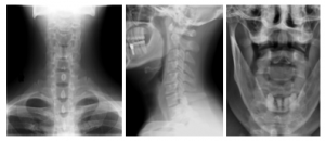 Three x-rays showing cervical spine injuries. Left: Anteroposterior view; Center: Lateral view; Right: Odontoid View