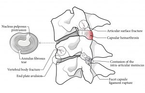 Line drawing of three stacked cervical vertebrae with intervertebral discs. The vertebrae are showing articular surface fracture, capsular hemarthrosis, contusion of the intra-articular meniscus, facet capsule ligament rupture, end plate avulsion, and vertebral body fracture. Inset illustration of intervertebral disc showing nucleus pulposus protrusion and annulus fibrosis tear.