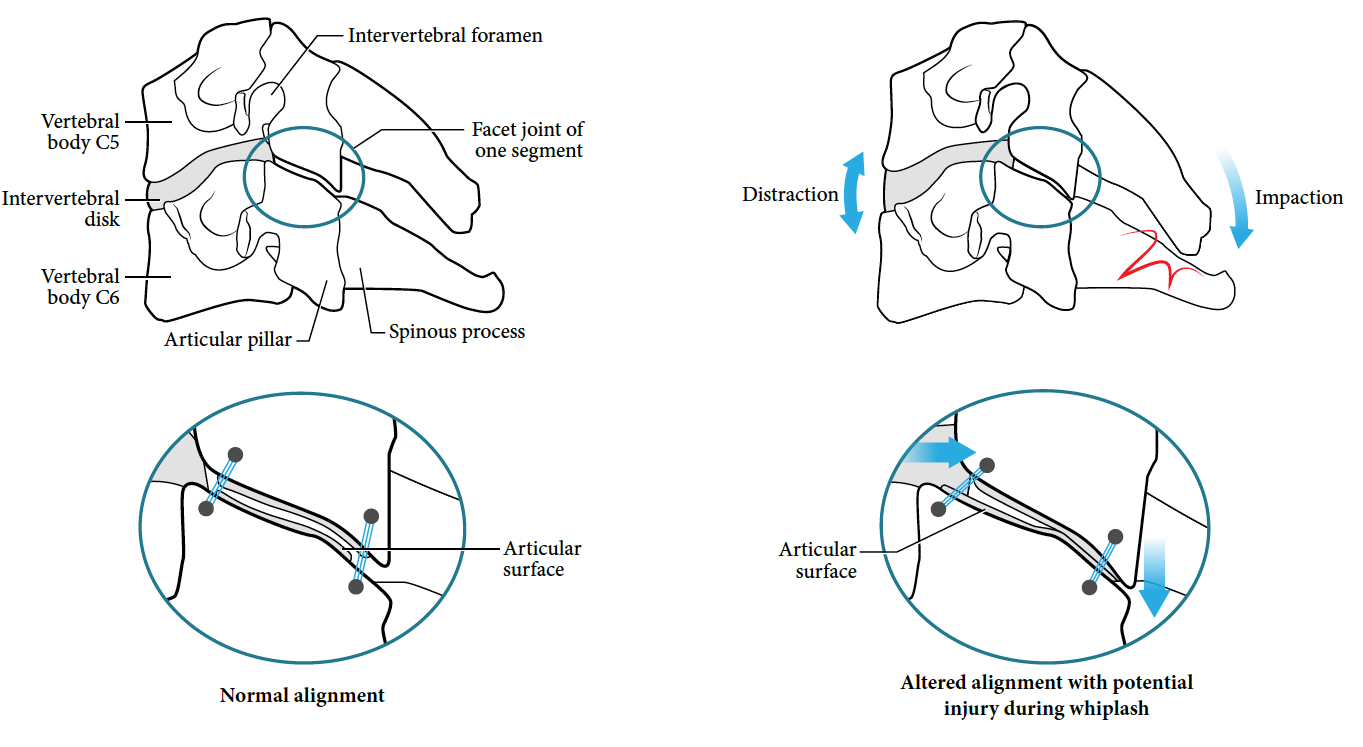 Mechanisms Of Whiplash Injury Whiplash Injury And Chronic Pain The