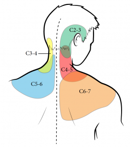 Line drawing of upper torso and head (posterior view), with coloured patches to indicate the area of pain referral pattern associated with facet joints between C2-3, C3-4, C4-5, C5-6, and C6-7