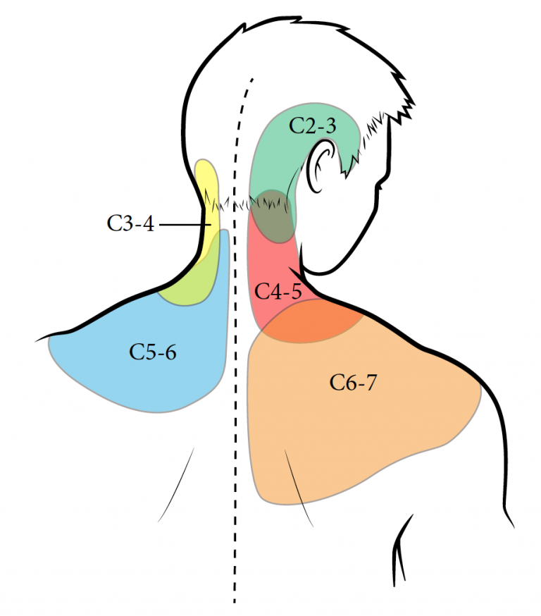 Amanda is Referred to a Pain Clinic – Whiplash Injury and Chronic Pain ...