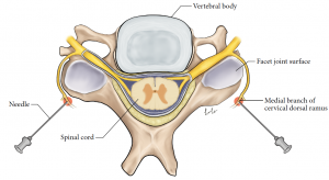 Illustration of single cervical vertebra, superior view, showing needles injecting the left and right medial branches of the dorsal root ganglions