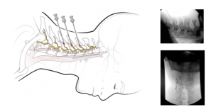 Illustration of neck anatomy (lateral view) with three needles shown to demonstrate the radiofrequency procedure. Accompanying radiographs of the neck showing needle placement (lateral and anteroposterior views)