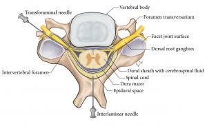Illustration of single cervical vertebra (superior view) showing placement of transforaminal needle and interlaminal needle injection sites. Vertebral and nerve anatomy labeled.