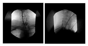 Two fluoroscopic images. Left image shows needle placement and spread of dye in the lateral epidural space. Right image is a lateral view showing vertical spread of solution
