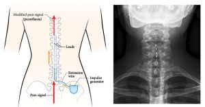 Left panel: Illustration of torso and hips (posterior view) showing spine and hip bones and lead placement for neurostimulation. Position of impulse generator also shown. Right panel: Radiograph of cervial spine, posterior view, showing placement of leads