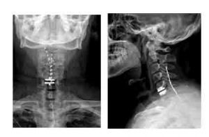 Two radiographs of cervical spine showing placement of neurostimulation leads. Left: anteroposterior view. Right: lateral view