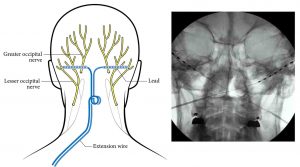 Left panel: Illustration of posterior view of head showing placement of peripheral stimulation leads for occipital nerve stimulation. Right panel: Radiograph of cervical spine showing placement of leads for occipital nerve stimulation