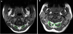 Two functional magnetic resonance images showing the rectus capitus posterior minor muscle outlined in green. Left image, normal appearance. Right image, shows fatty infiltrates