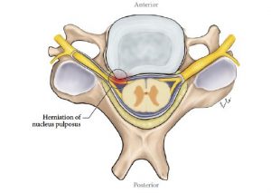 Illustration of a cervical vertebra and disc, showing a herniation of the nucleus pulposus against a nerve