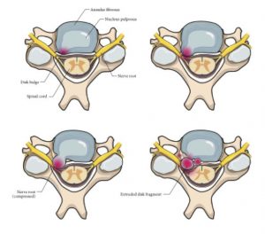Four illustrations of a cervical vertebra with associated intervertebral disc, showing a bulging herniation, a protruding herniation, a prolapsed or ruptured herniation, and a sequestered or free fragment herniation, respectively and their compression of the nerve root
