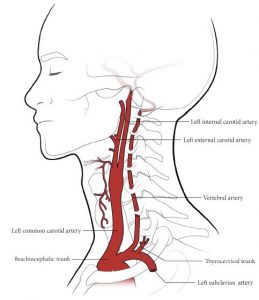 Line drawing of head and neck illustrating the branches of the left common carotid artery, the vertebral artery and and the left subclavian artery. Lateral view.