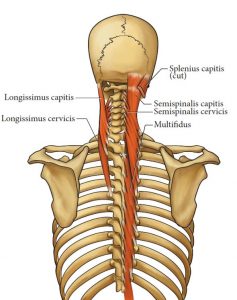 Illustration of the back, neck, and skull bones (posterior view) showing the longissimus capitus, longissimus cervicis, splenius capitis (cut), semispinalis capitus, semispinalis cervicis, and multifidus muscles and their attachment points