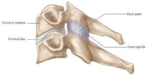 Illustration of lateral view of two stacked cervical vertebrae. Facet joint, facet capsule, cervical disc are labelled