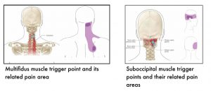 Two images in this section. Left image shows the position of multifidus in relation to the cervical spine, with the trigger point marked by a circle. The related pain area is shown on the neck extending from the base of the skull to the level of scapula. Right image shows position of obliquus capitus superior and inferior muscles, and rectus capitis posterior minor and major muscles. Trigger points on these muscles refer pain to the side of the head, extending from the occiput over the ear to the temporal area