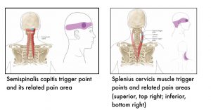 Two images in this section. Left image shows the position of semispinalis capitis muscle in relation to the cervical spine, with the trigger point marked by a circle. The related pain area is across the side of the head over the ear. Right image shows position of splenius cervicis. Superior and inferior trigger points on these muscles refer pain to the back and side of the head, and side of the neck, respectively