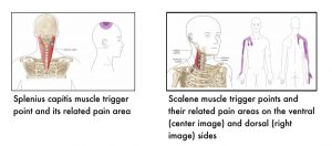 Two images in this section. Left image shows the position of splenius capitis muscle in relation to the cervical spine, with the trigger point marked by a circle. The related pain area is the top of the head. Right image shows position of scalene, with four trigger points marked. Pain is referred to the shoulder, outside of arm, and thumb on the ventral and dorsal sides