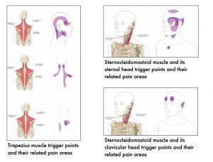 Three images in this section. Left image shows the position of trapezius muscle in relation to the cervical and thoracic spine, with various trigger points marked by a circle. The related pain areas are as follows: superior fibers of trapezius refer pain to to side of head, neck, and jaw. Middle fibers of trapezius refer pain to side of neck from occiput to top of scapula, and medial border of scapula. Inferior fibers of trapezius refer pain from the top of the neck to below the scapula and superior to scapula. Top right image, sternocleidomastoid muscle to sternal head, with four trigger points refer pain to top of head, side of head and around eye and cheek, tip of chin, front of neck, and superior border of sternum Bottom right image, sternocleidomastoid muscle to clavicular head with three trigger points refer pain to forehead over right and left eyes, and to side of head behind the ear