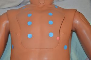 Auscultate anterior chest; ten blue dots are placed on the chest, three on each side of the breastbone, two on each shoulder, two in underarm