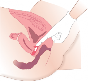 Administering medication vaginally without an applicator