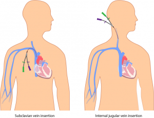 Central venous catheters