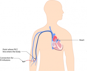 PICC line inserted in the upper arm (through the basilic vein)