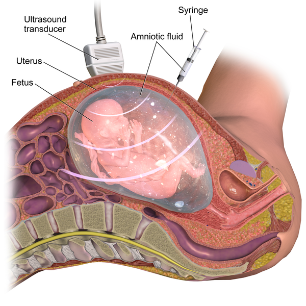 graphic of amniocentesis