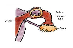 graphic of an ectopic pregnancy