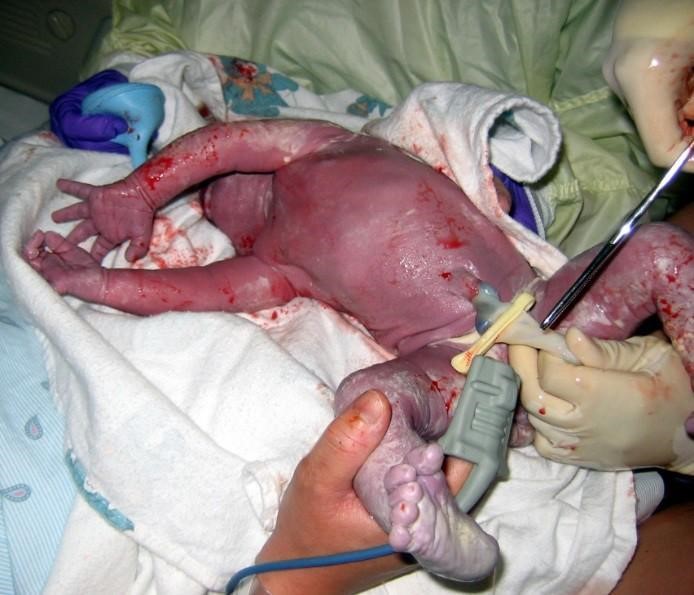 image of a health professional cutting the umbilical cord of a newborn