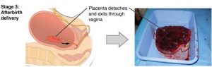 Stage 3: Afterbirth delivery. Placenta detaches and exits through vagina. Image of Placenta in a square plastic bin.