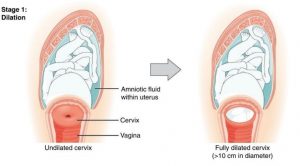 Stage 1: Dilation. Image of fetus pressed against closed (undilated) vs open (dilated) cervix.
