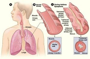 Images of airways of normal lungs vs asthmathic (with thickened artery wall)