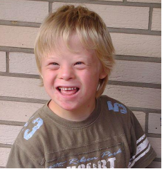 Image of a child with Down's syndrome