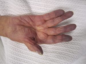 An elderly person's hand, with the finger tips turning blue due to lack of oxygen.