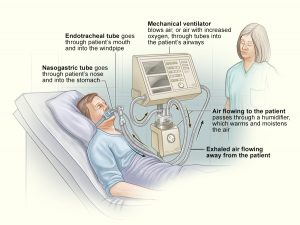 A diagram of the parts of the mechanical ventilator