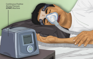 A drawing of a man using a CPAP machine while sleeping in bed. The CPAP machine is labelled.
