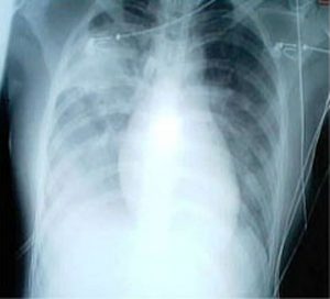 A lung x-ray of a SARS patient.
