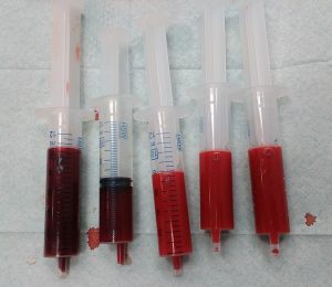 5 syringes of blood: the two on the left with darker blood are venous blood, while the three bright red samples on the right are arterial blood.