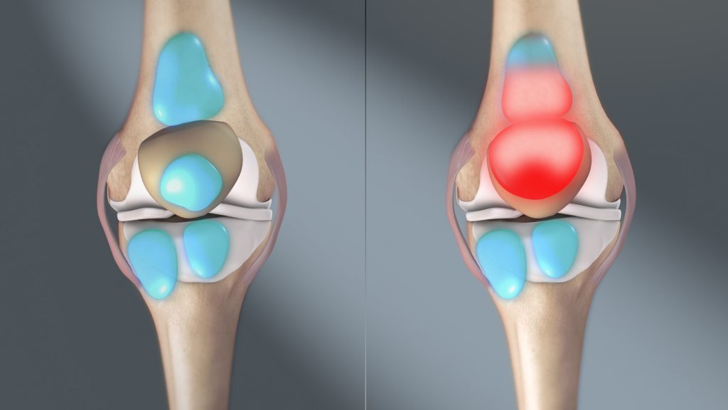 Knee Pain