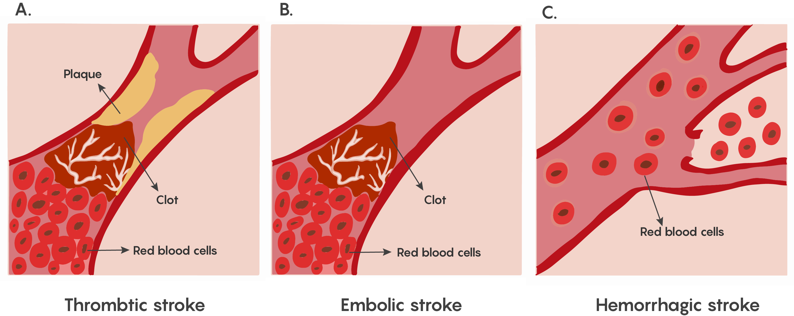 3-2-stroke-and-loss-of-blood-flow-as-an-acute-injury-to-the-brain