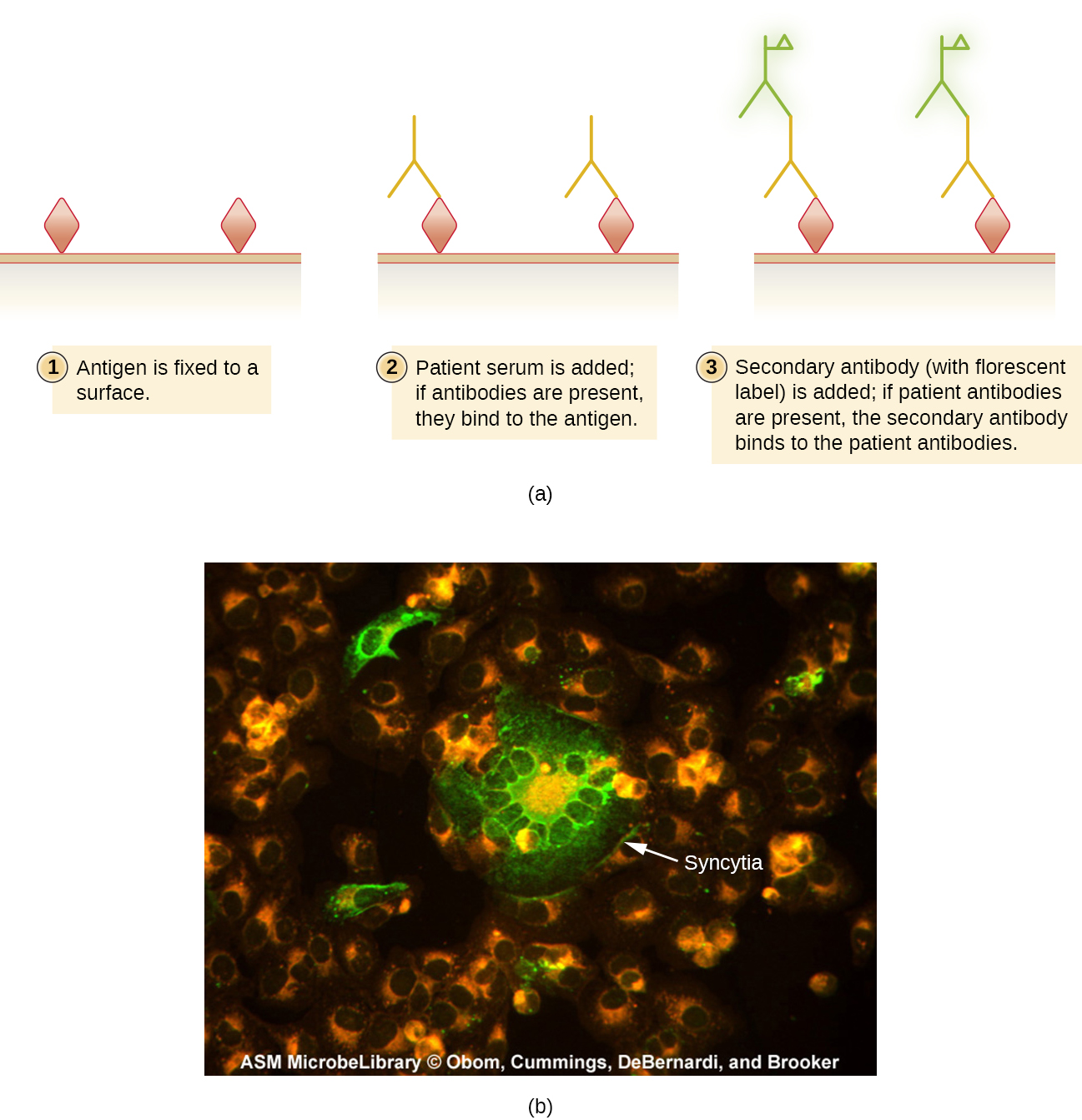 Panel (a) is a diagram depicting the procedure of indirect immunofluorescent assays. An unlabeled primary antibody binds to antigen on a microscope slide, then a secondary antibody, labeled with a fluorescent stain, binds the primary antibody. The complexes are visualized with a fluorescence microscope.  Panel (b) is a fluorescence micrography of aAn indirect immunofluorescent stain using a patient’s antibodies to the measles virus. The primary antibody binds to viral antigens on inactivated measles-infected cells affixed. Secondary antibodies bind the patient’s antibodies and carry a fluorescent molecule.