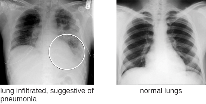Chest X-rays show ribs and other bones as white and the lungs as black. The left image has significant white cloudiness in the lungs. This lung infiltrate is suggestive of pneumonia. Normal lungs show a smooth, even black colour throughout the lungs.