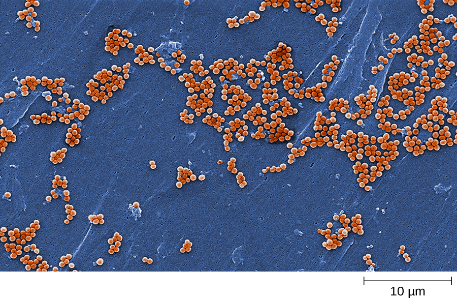 Staphylococcus aureus light microscopy. Morphology of Staphylococcus aureus  under the microscope. Micrograph of S.aureus, Gram stain. Gram-stained  smear from culture.