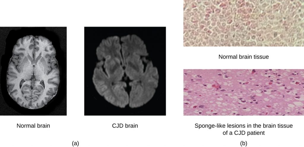 The CJD brain has larger spaces as seen by more black regions in the image of the whole brain. The micrograph shows holes in the brain tissue.