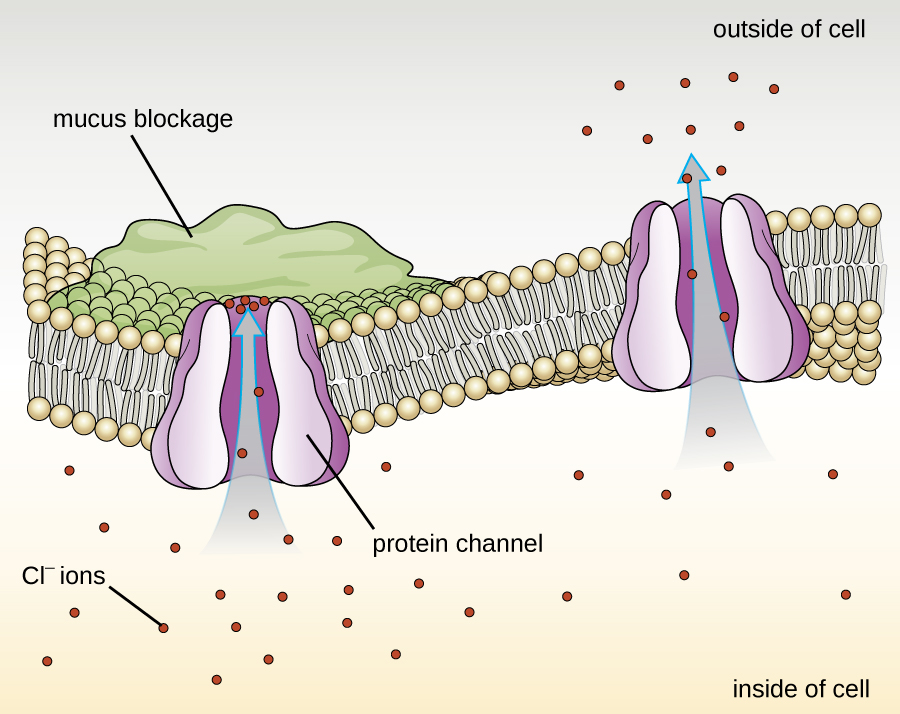 A drawing of a phospholipid bilayer in the centre with two protein channels. One is open and lets Cl- flow out of the cell. The other is blocked by a mucus blockage on the outside of the cell; Cl- ions can’t flow through this channel.