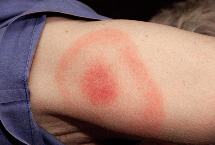 A photo of a bulls-eye rash; a red spot in the centre and a red ring around that.