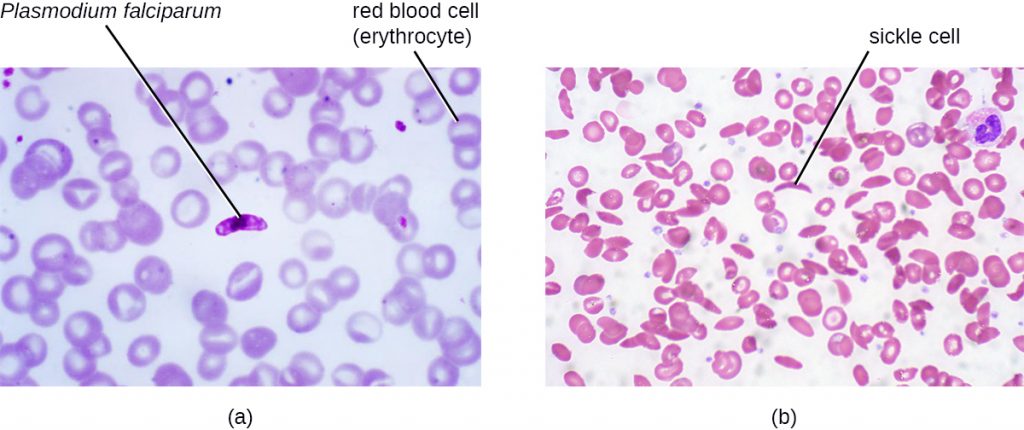 a) A micrograph showing round red blood cells (erythrocytes) and a darker oval cell (Plasmodium falciparum).b) A micrograph showing round red blood cells and a “C” shaped red blood cell labeled “sickle cell”.