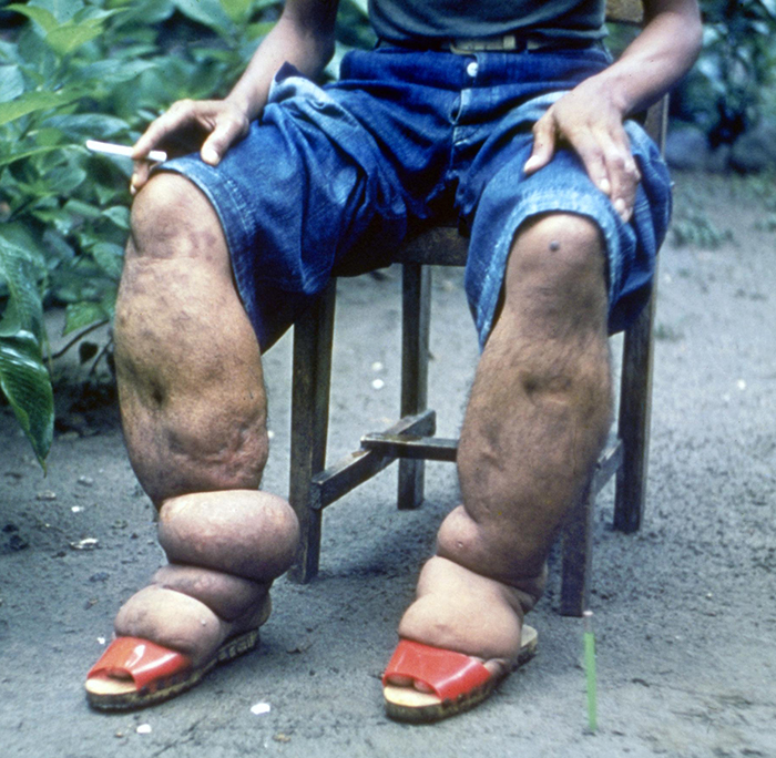 A photo of a person with extremely swollen lower legs.
