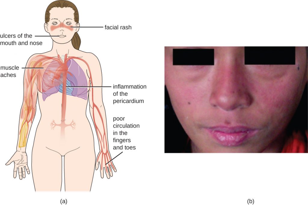 a) Diagram of symptoms include: a rash on the phase, ulcers of the nose and mouth, muscle aches, inflammation of the pericardium (heart region), poor circulation in the fingers and toes. B) photo of a butterfly rash on the face.