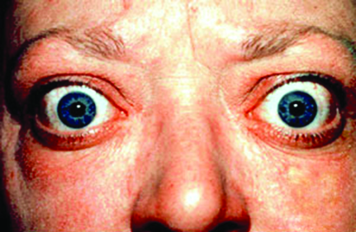 Photo of a person with large bulging eyes.
